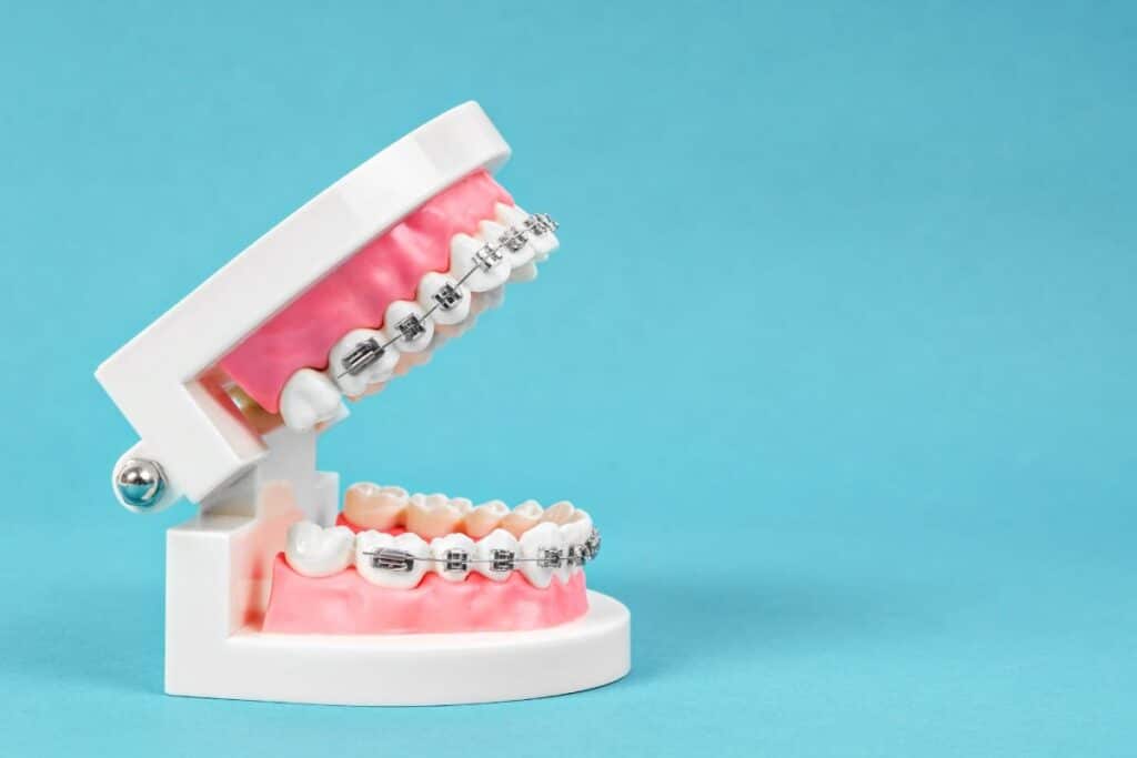 Metal Braces in Layton