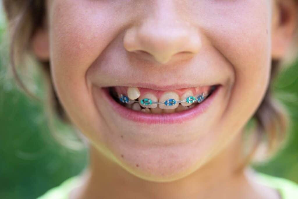 Braces for Children in Layton