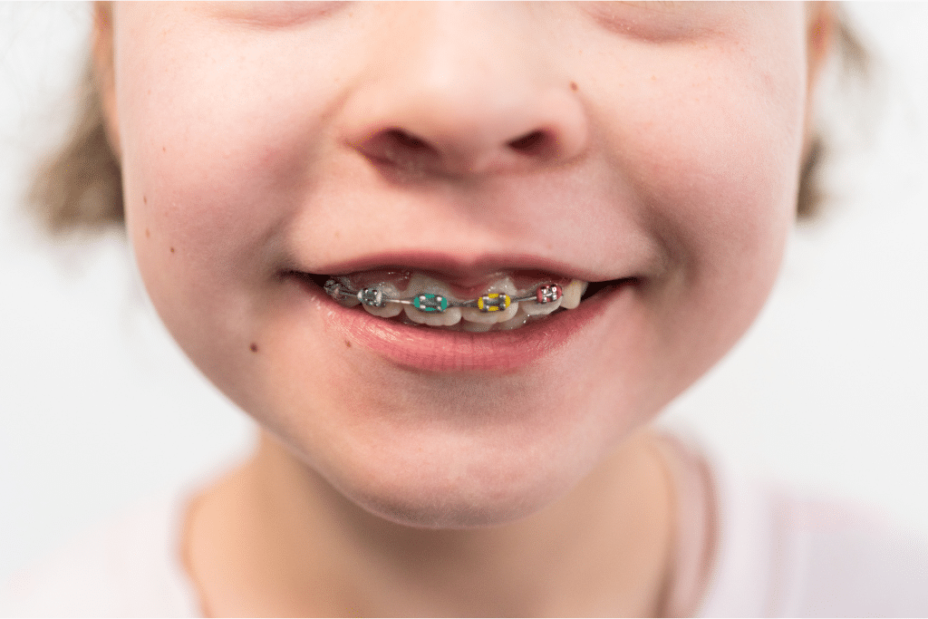kids orthodontic treatment in Layton